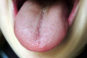 Halitosis
